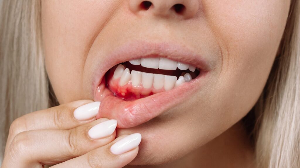 Lack of vitamin C can cause scurvy.