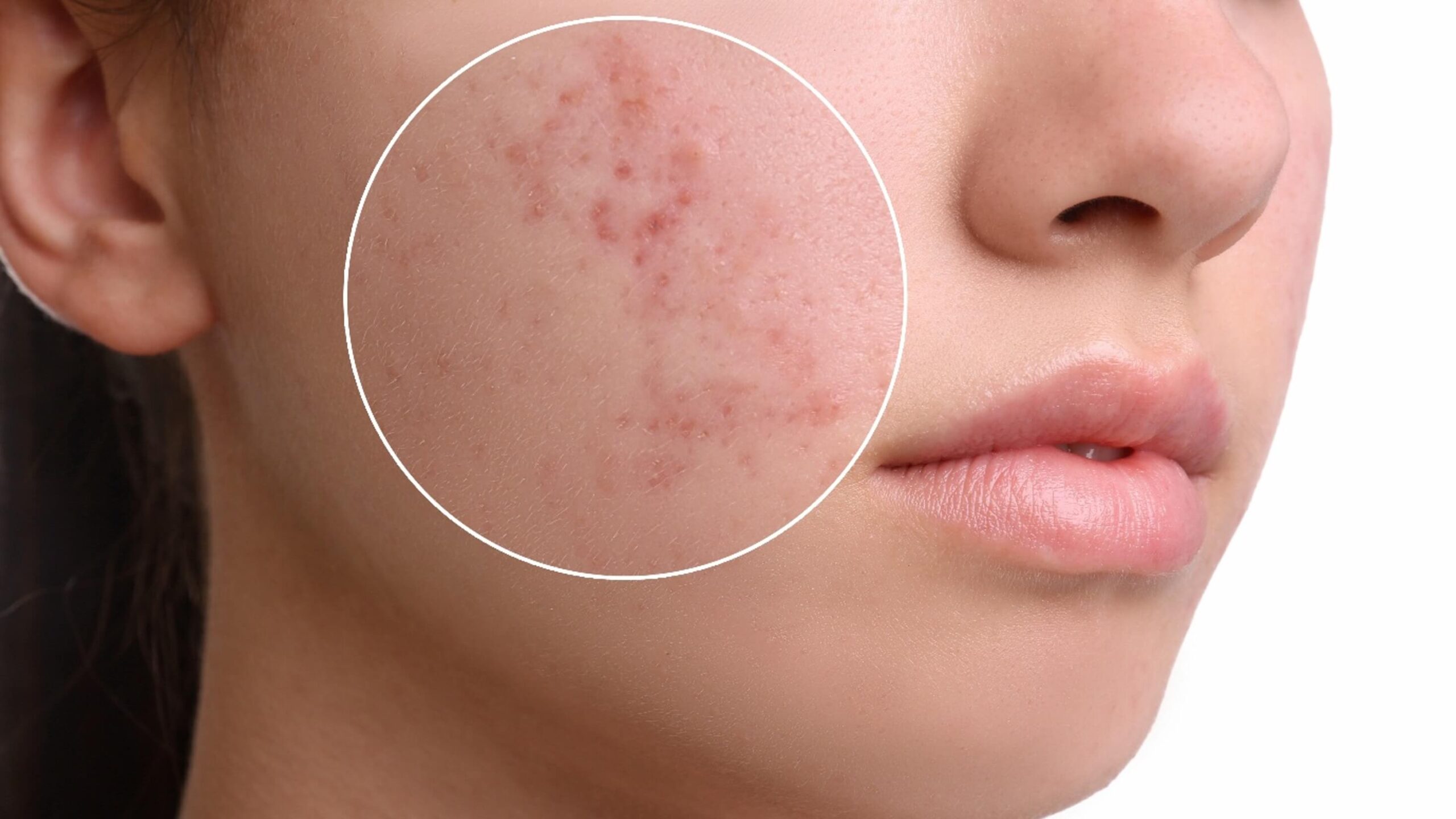 Close-up of irritated skin and breakouts.