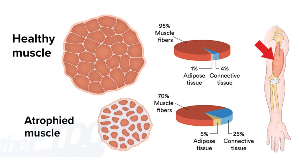 Understand what leads to muscle atrophy and how it affects your health and daily activities.