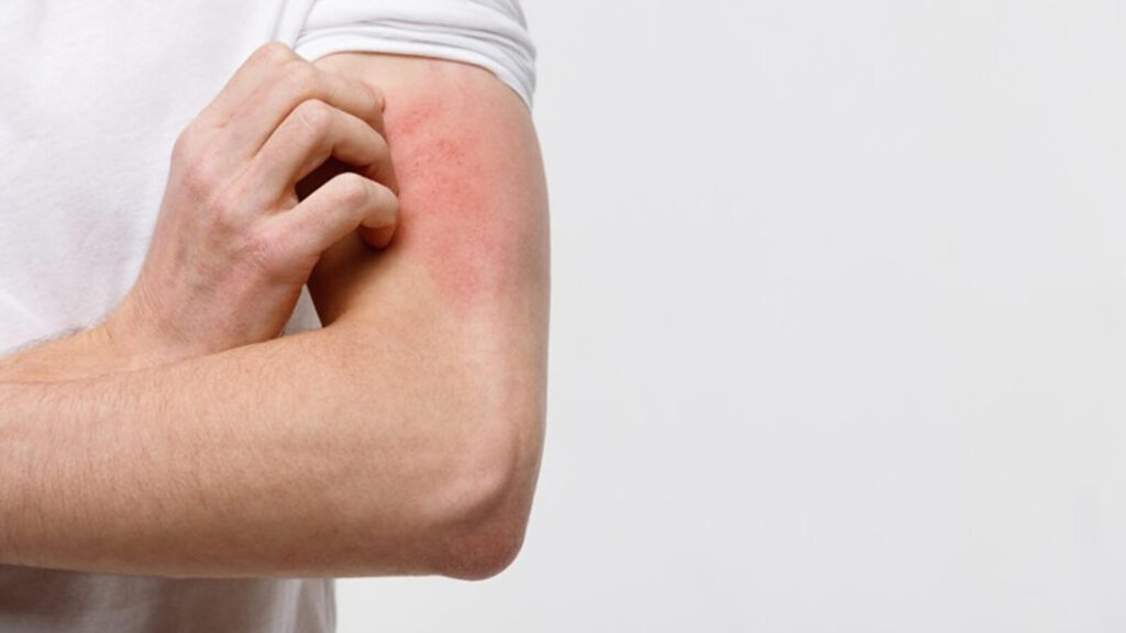 Spotting early allergy symptoms can prevent severe reactions.