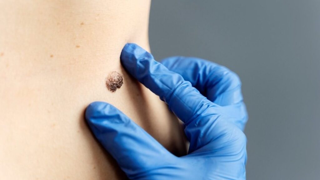 Learn how prolonged UV exposure and genetic factors contribute to skin cancer.