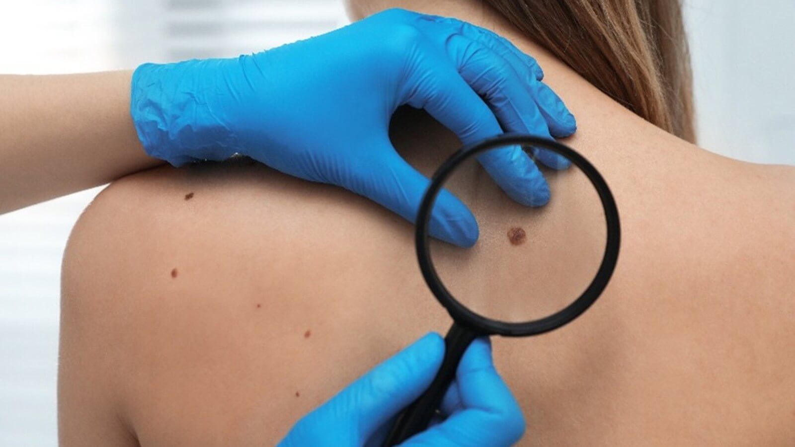 Regularly perform skin self-exams to spot unusual moles or changes early.